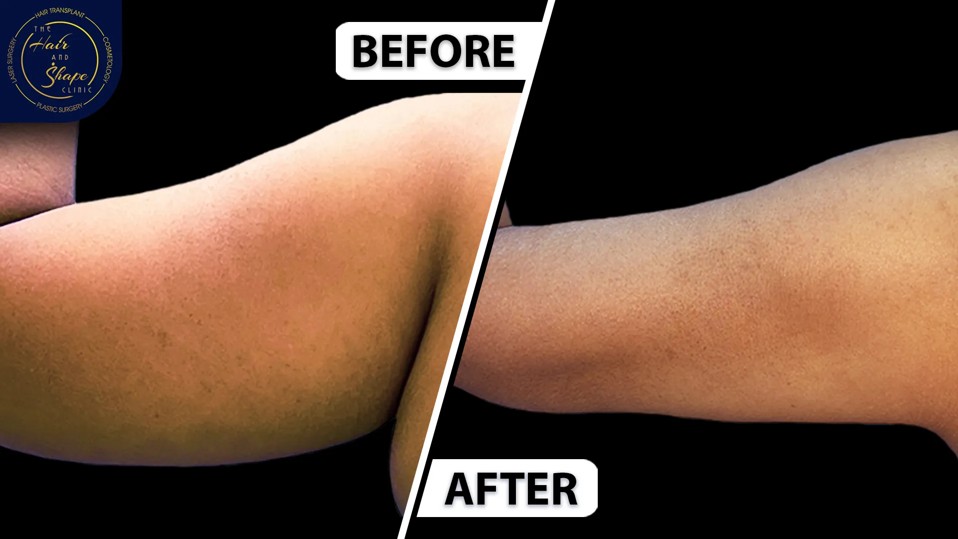 Arm lift result8